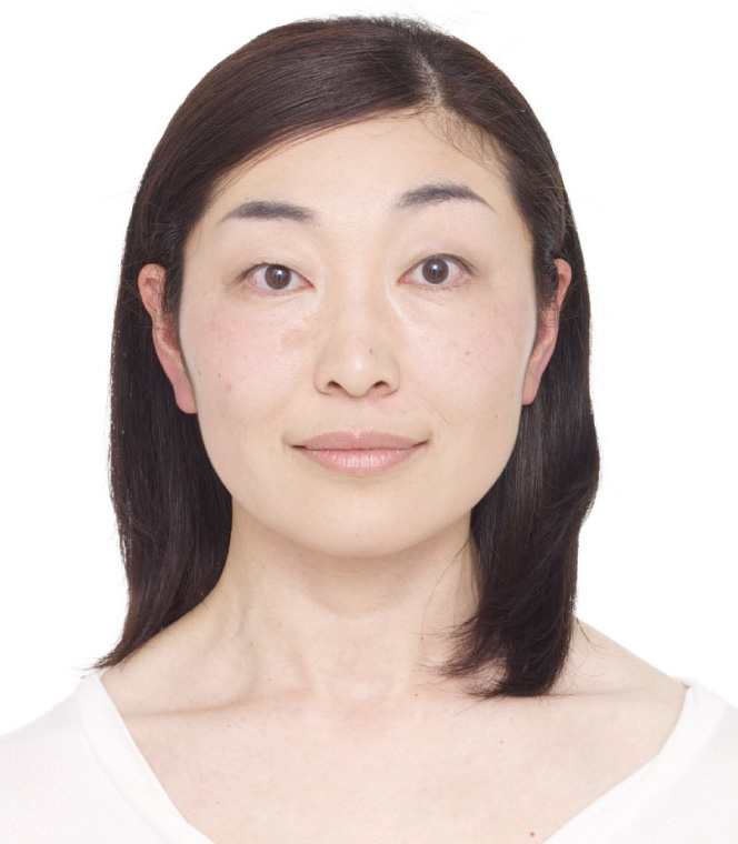 紫外線によって起こる老人性色素斑の説明画像