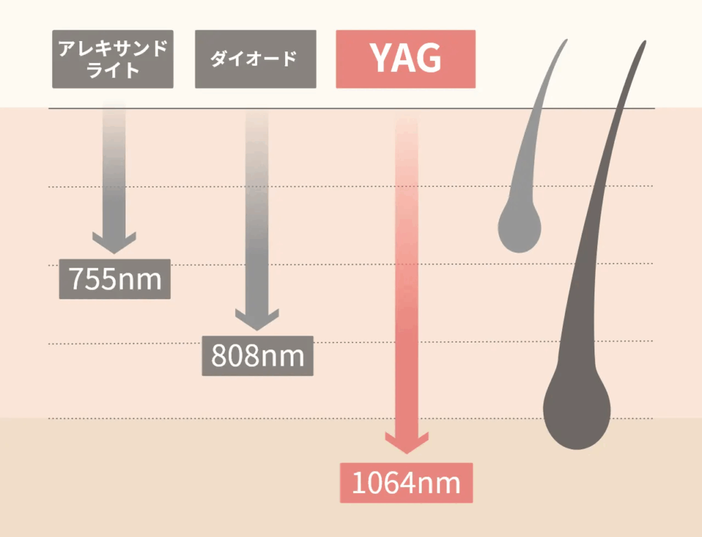 ヤグレーザーの画像