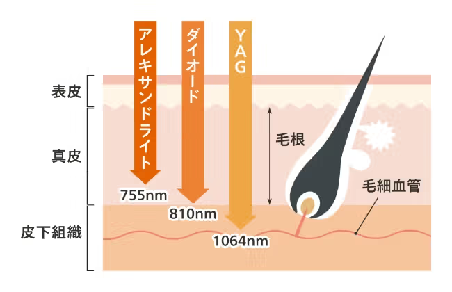 ヤグレーザー含む3種の異なるレーザーを搭載の画像